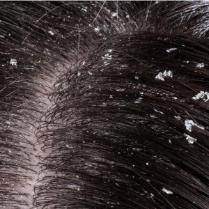 Dry scalp & hair